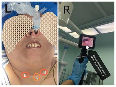 Case report: Nasal polyp exfoliated into the tracheal tube in a patient with a difficult airway during nasotracheal intubation